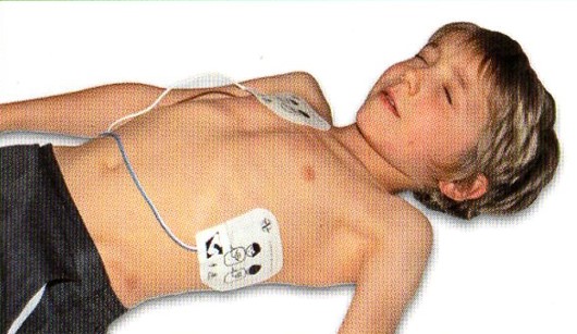 Paediatric-AED-pads